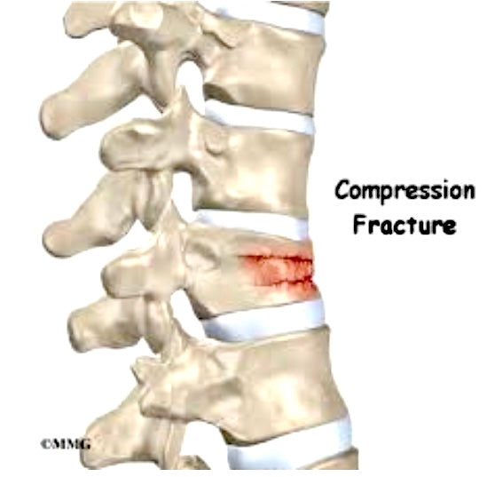 Osteoporosis/Osteopenia - Our bones and EVOO - Blog # 33