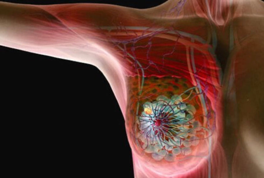Breast Cancer Prevention - Blog # 43