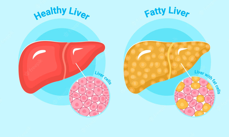 Do You Have a Fatty Liver? - NAFLD and EVOO - Blog # 62