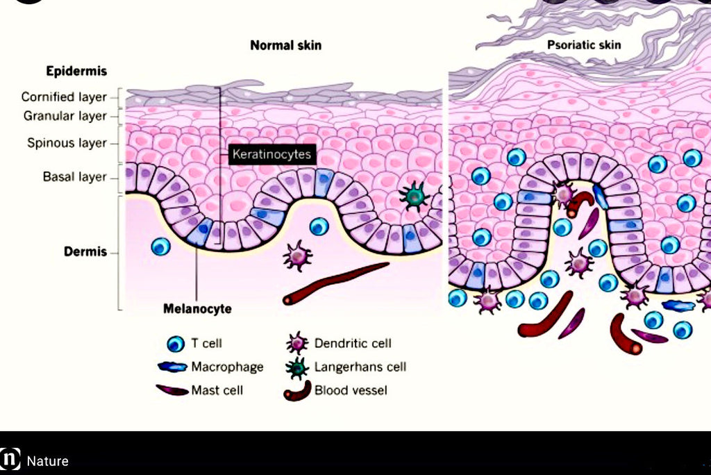 Psoriasis - Can I Get Rid Of This? - Blog # 49