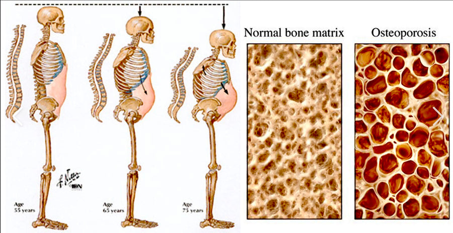 詳解骨質疏鬆症 - 骨質流失根源和對策